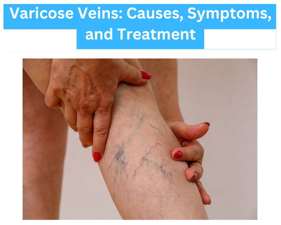 Varicose Veins: Causes, Symptoms, and Treatment